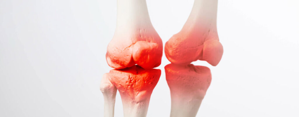 Understanding Inflammation’s Role in Knee Pain